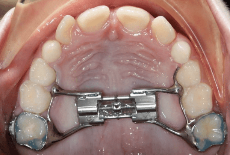 Expander orthodontics - a revolutionary approach to correcting dental misalignments