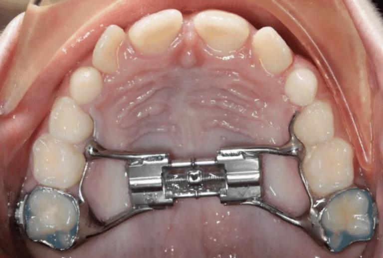 What is an Orthodontic Expander & When is it Necessary?