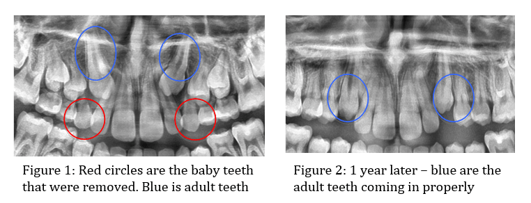 baby-teeth-extract