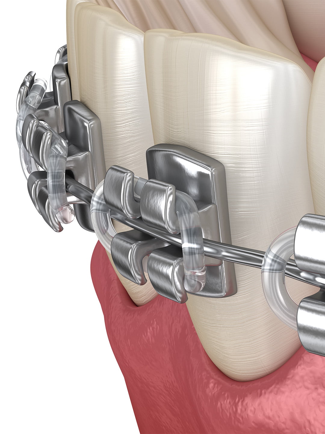 Metal Braces Treatment Traditional Orthodontics By Dr Gilbert