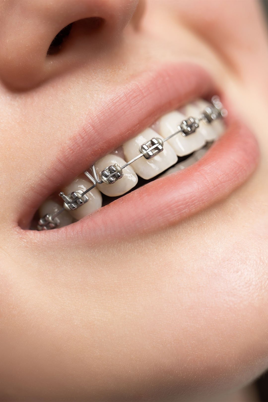 Metal Braces Treatment Traditional Orthodontics by Dr. Gilbert