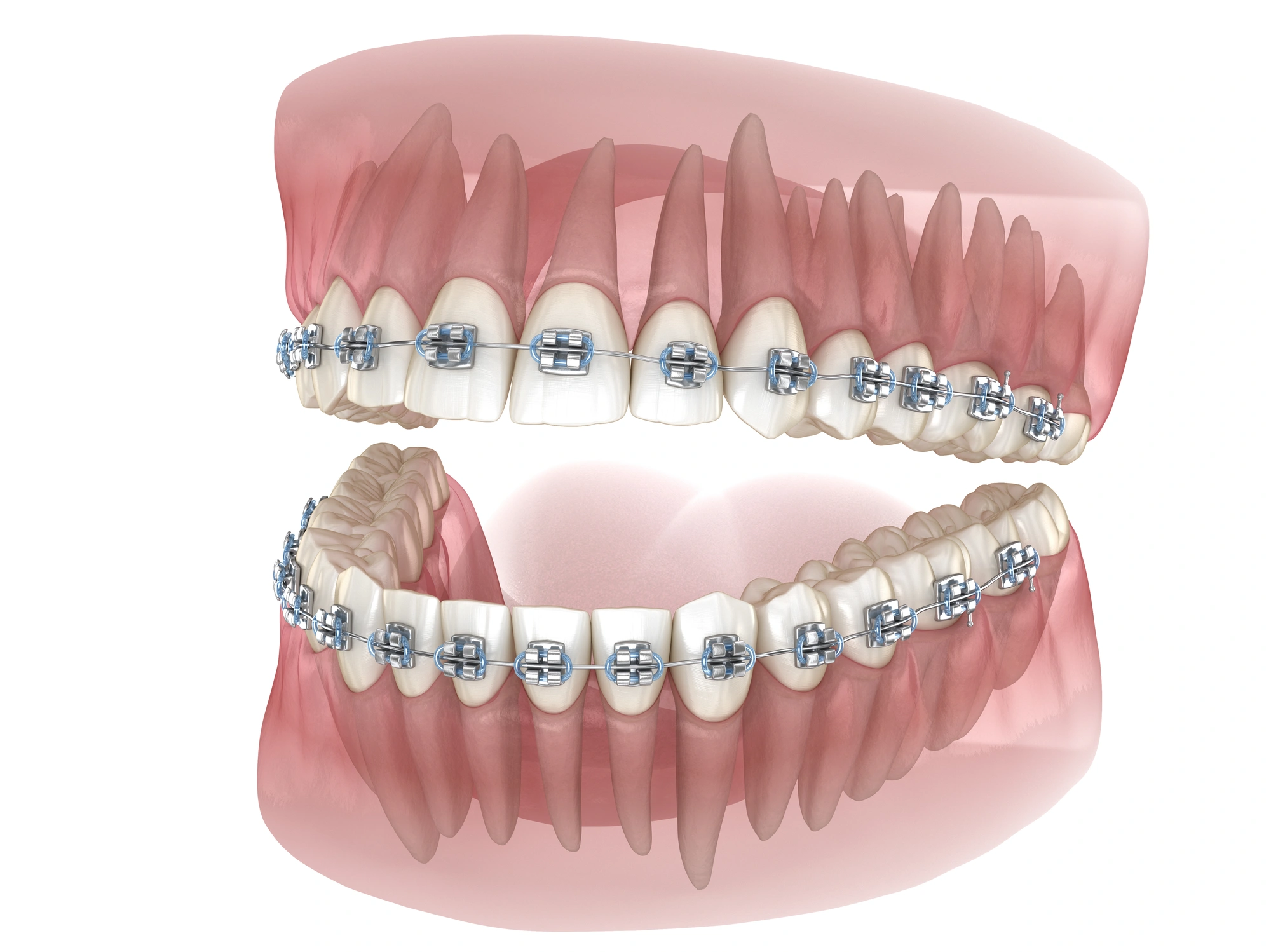 klowen stride Custom Braces in Central Ohio Designed for Faster Results KLOwen Orthodontics | Products