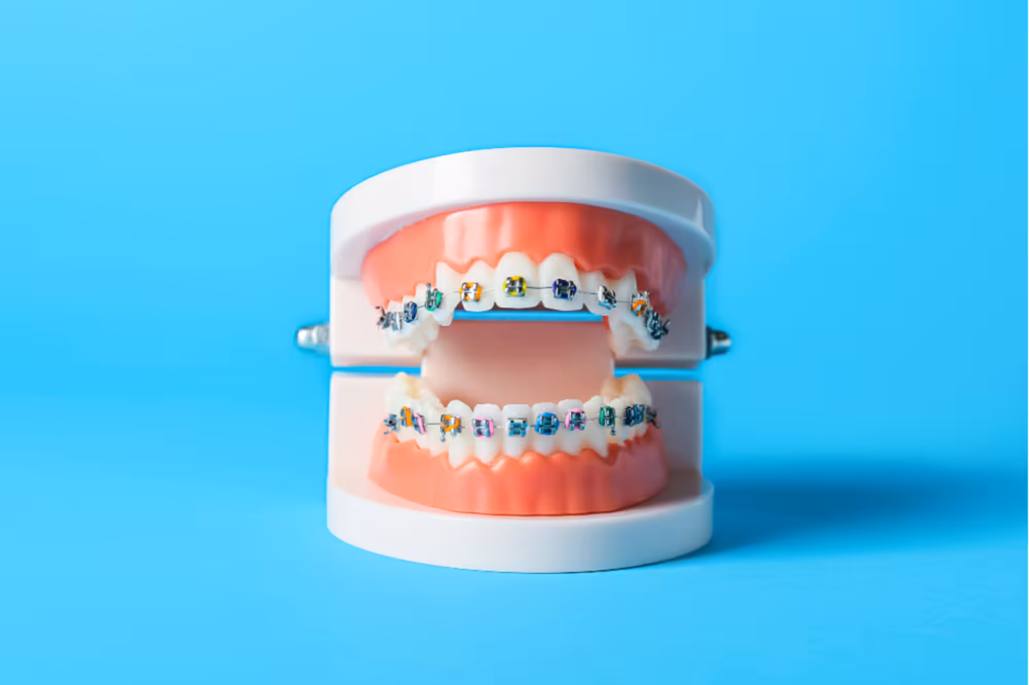 0824 Does It Hurt to Get Braces Put On 5 0824 Does It Hurt to Get Braces Put On 5